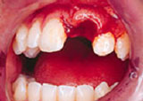 Image broken tooth