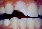 Image chipped tooth
